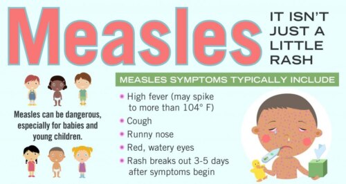 Chart headed "Measles - It isn't just a little rash" showing illustrations of children with comment "Measles can be dangerous, especially for babies and young children" and "Measles symptoms typically include: High fever (may spike to more than 104 degrees F); Cough; Runny nose; Red, watery eyes; Rash breaks out 3-5 days after symptoms begin"